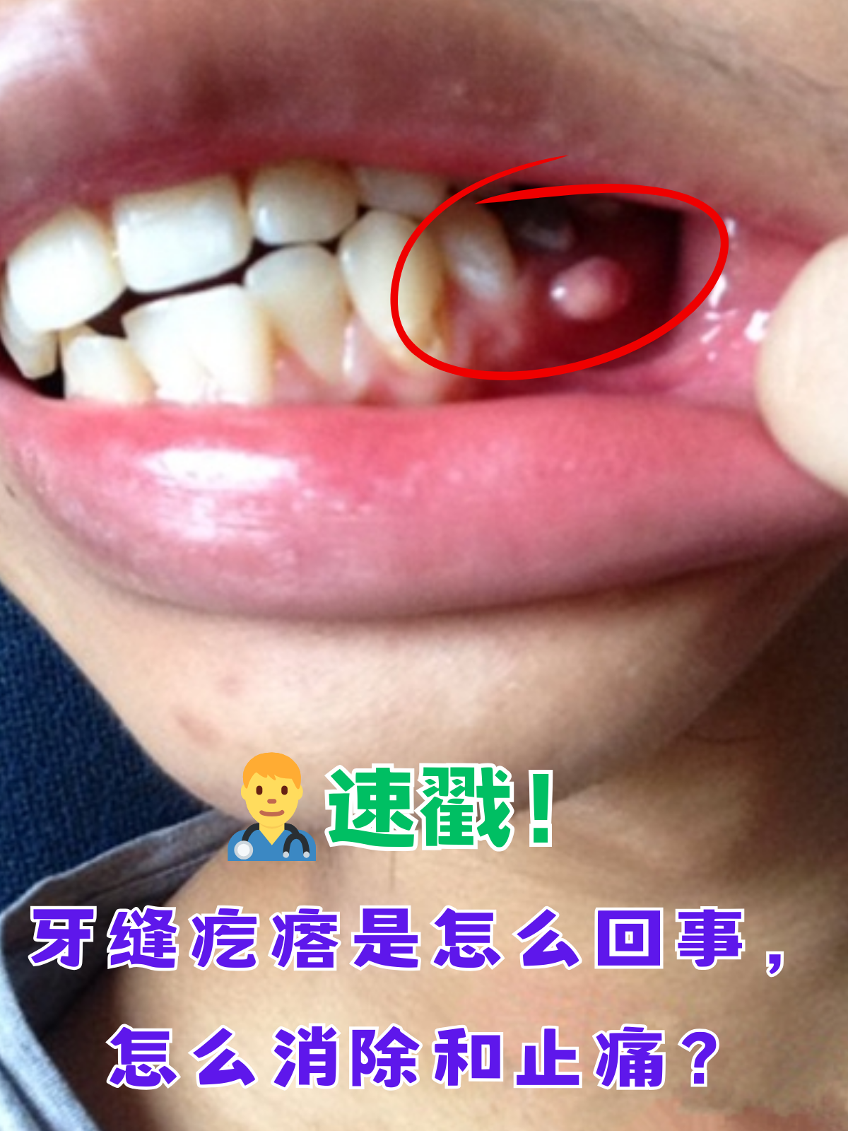 牙齿边上长了个肉包怎么办牙龈旁边长个肉疙瘩怎么办牙龈长了个肉芽要