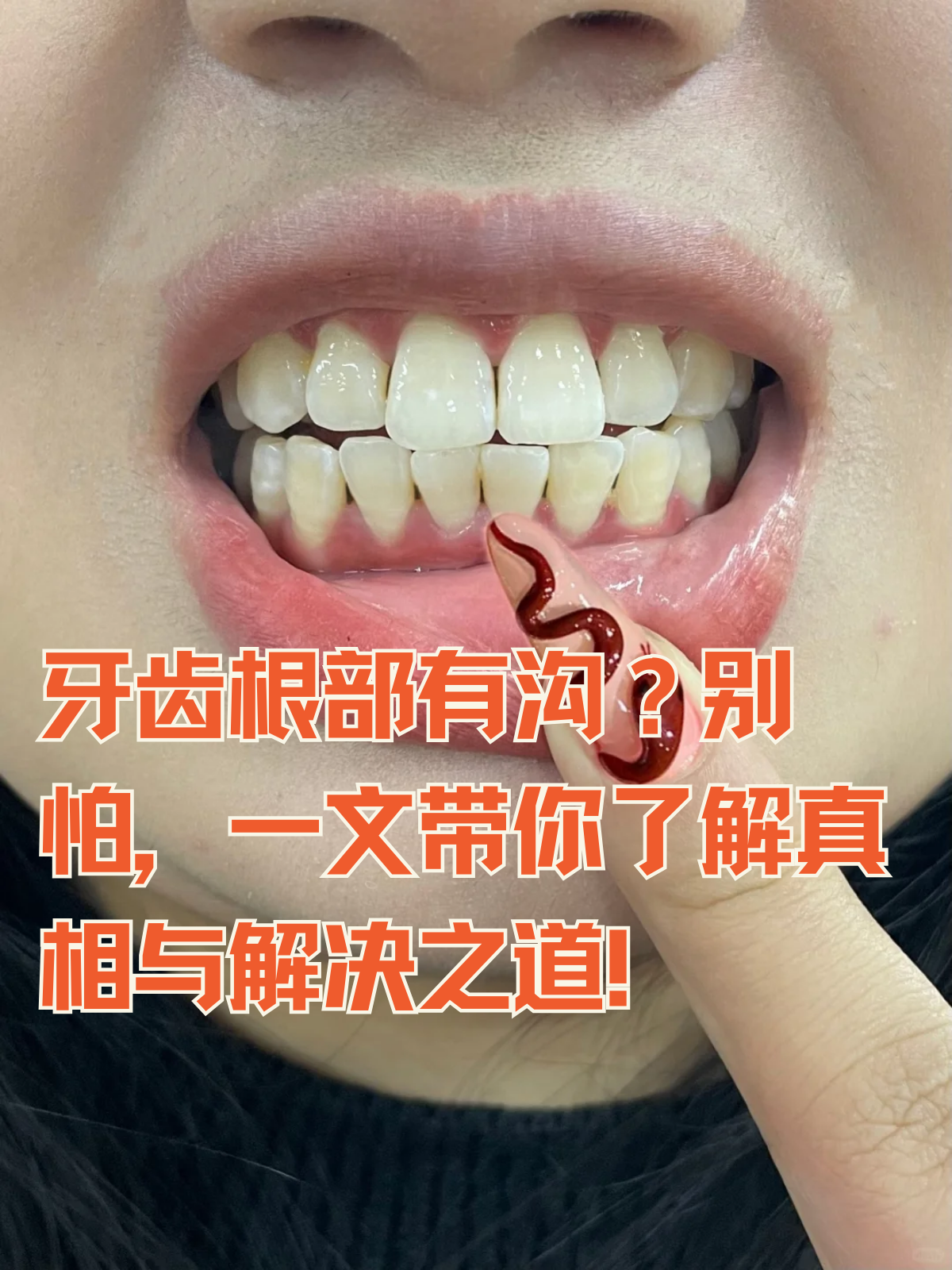 在关注口腔健康的过程中,有些朋友可能会发现牙齿外侧根部出现了一道