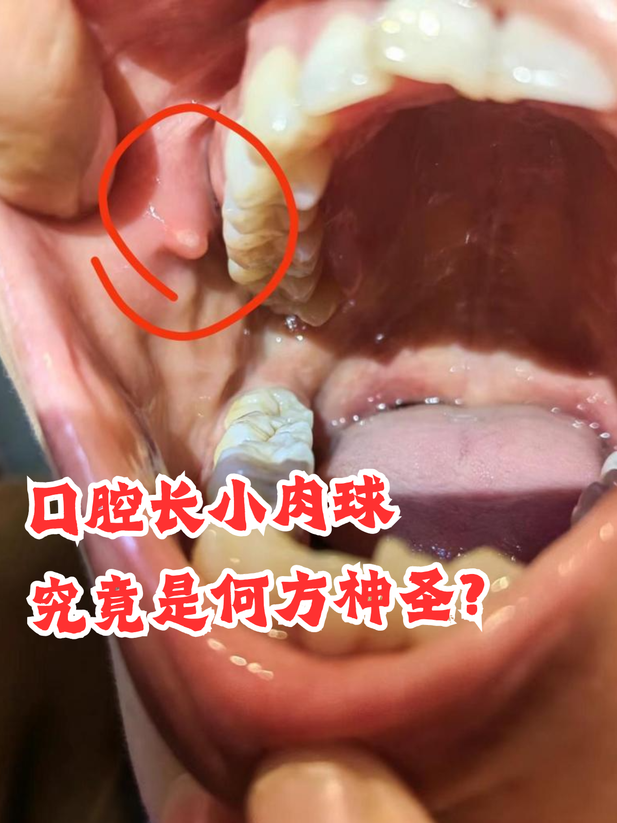 口腔健康一直是大家关注的重点,而口腔中的小肉球