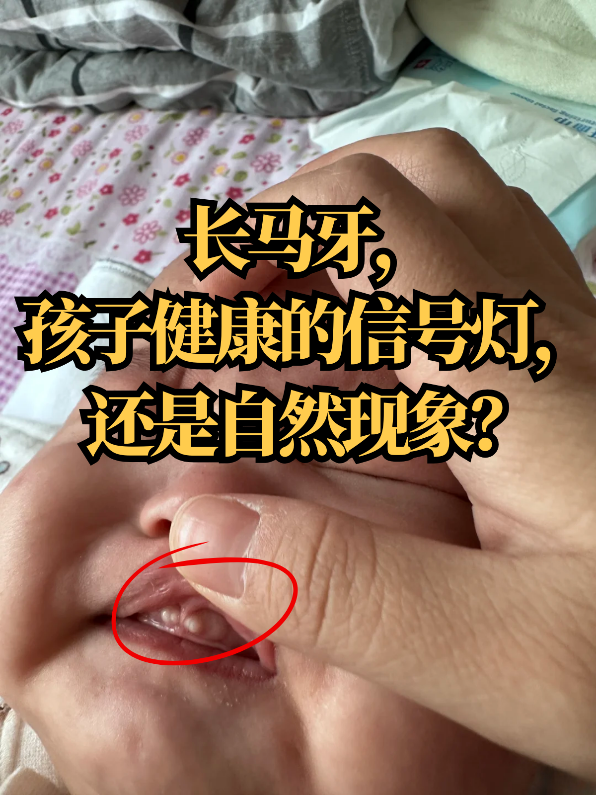 马牙,医学上称为"上皮珠",是新生儿常见的一种生理现象,通常出现在