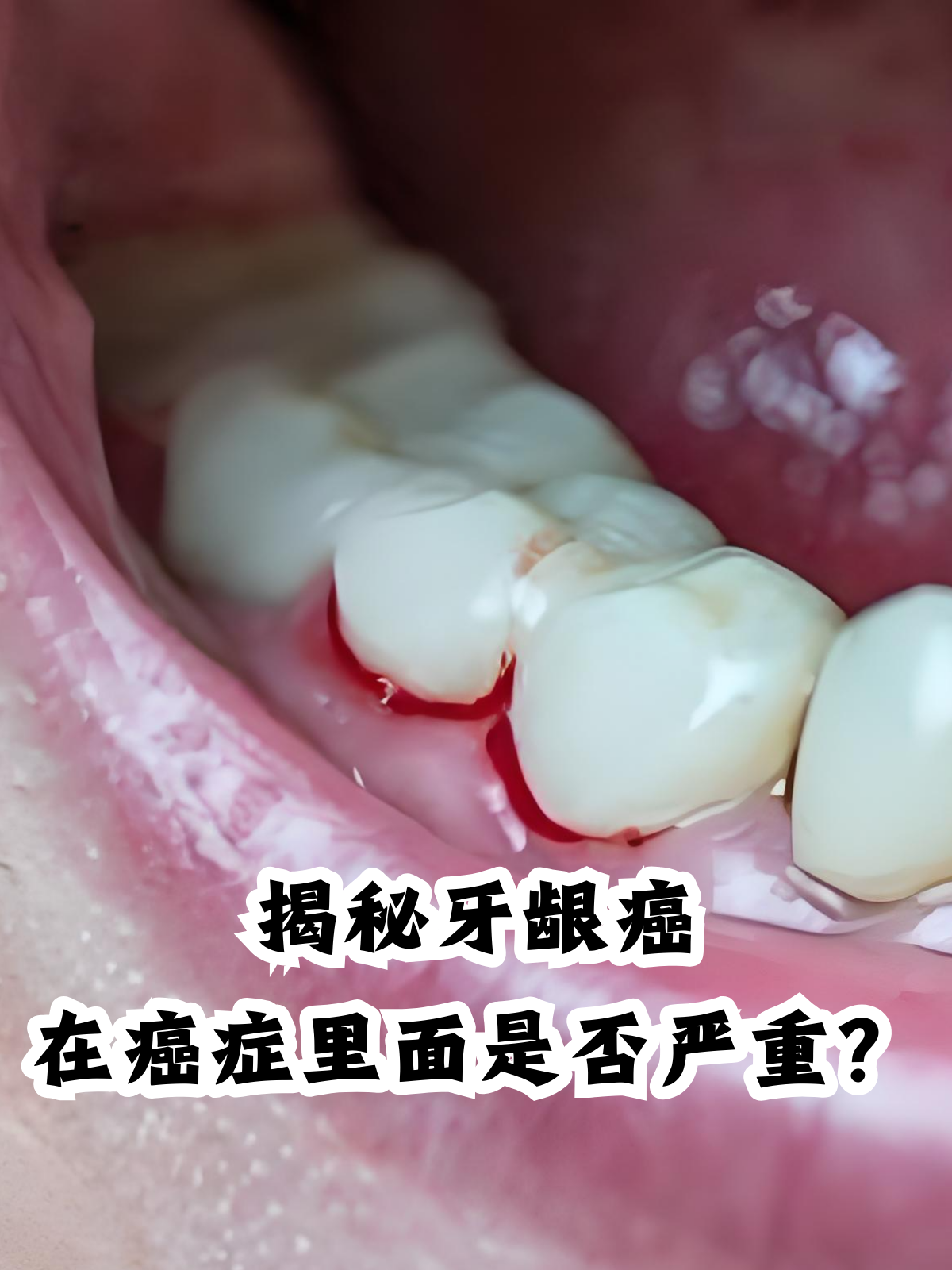 牙龈癌作为口腔癌的一种,是发生在牙龈区域的恶性肿瘤