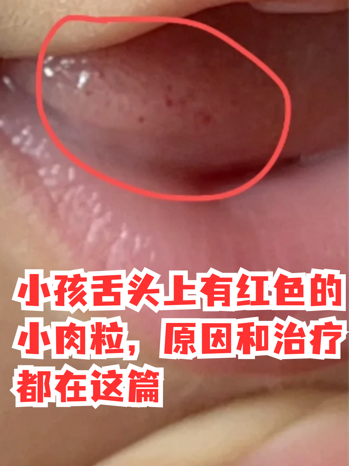 小孩舌头上有红色小肉粒,可能是由多种原因引舌尖长小肉粒图片舌头