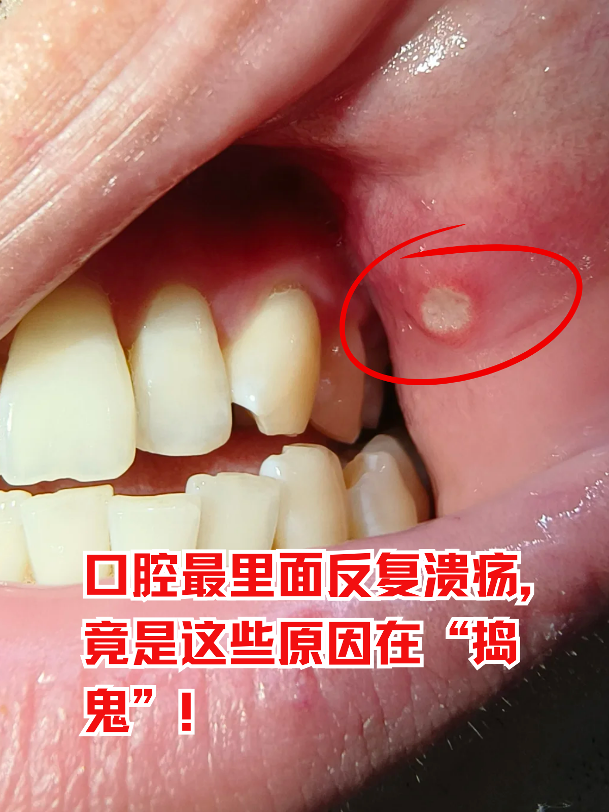 每次吃东西时,口腔溃疡传来的刺痛感,让不少人苦不堪言