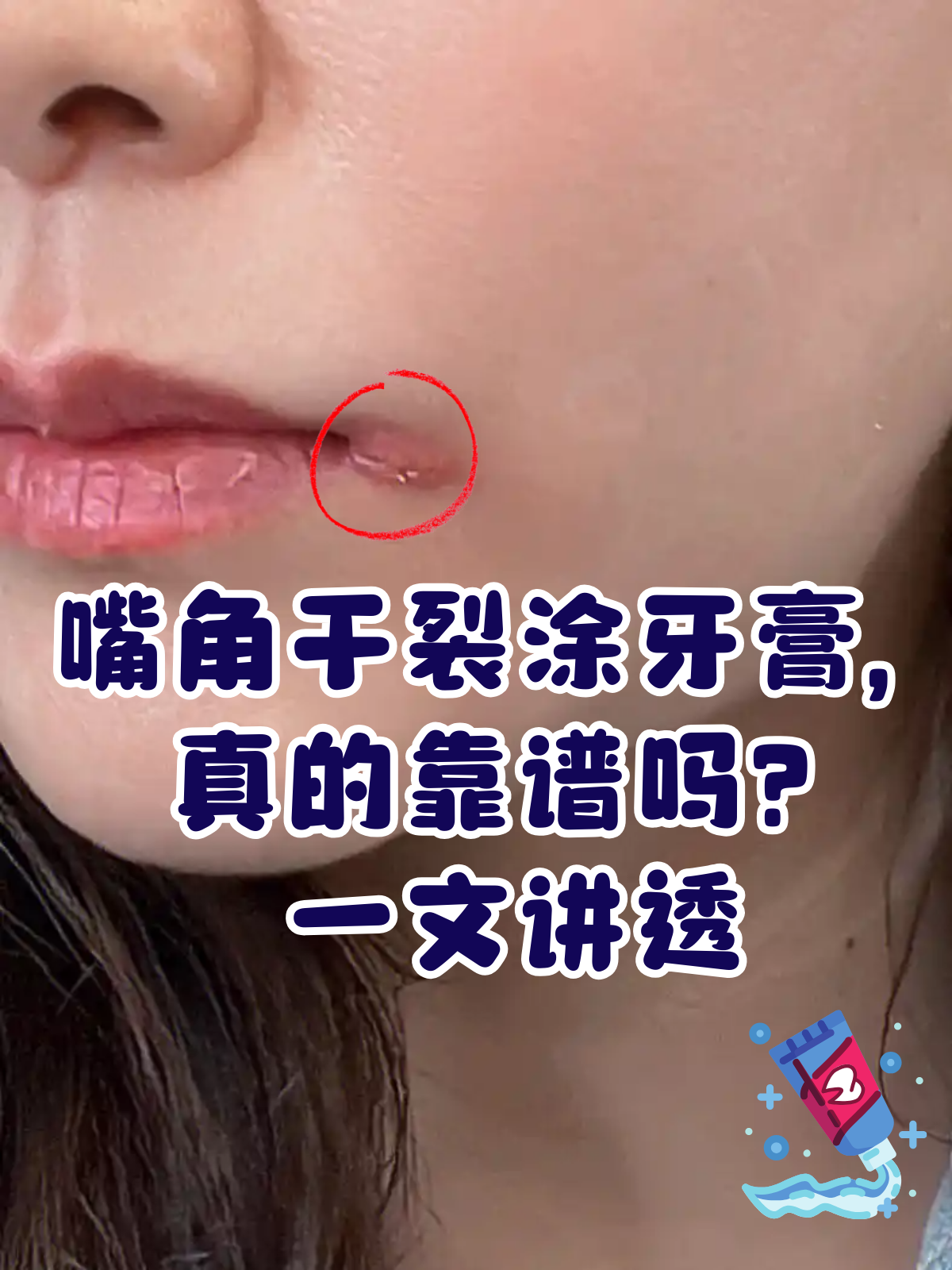 一文讲透 嘴角干裂,溃烂时,有人会尝试用牙膏涂抹促进愈合