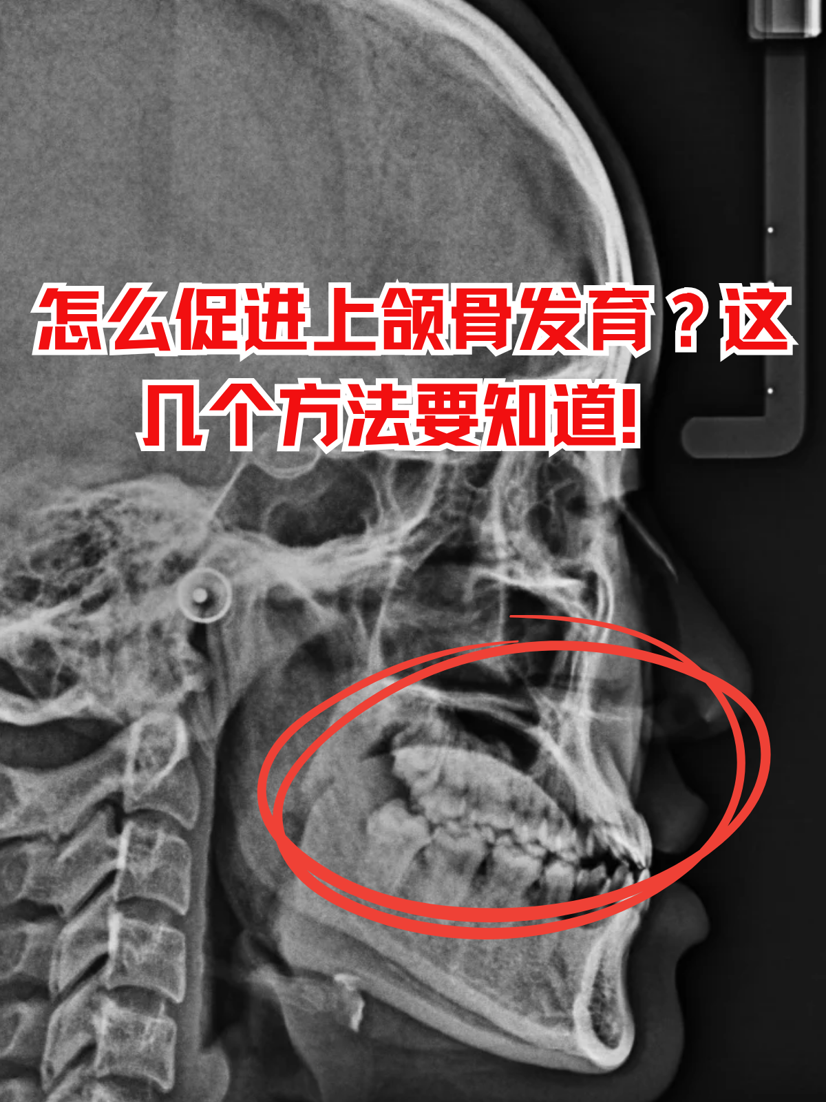 孩子换牙期牙齿排列不整齐,或是面型看着"塌鼻梁,下巴前突",不少家长