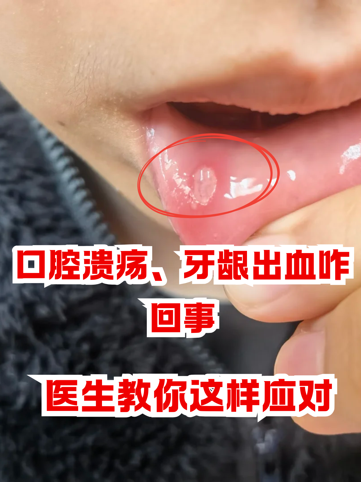 口腔溃疡,牙龈出血咋回事医生教你这样应对 有没有人正准备享用美食时