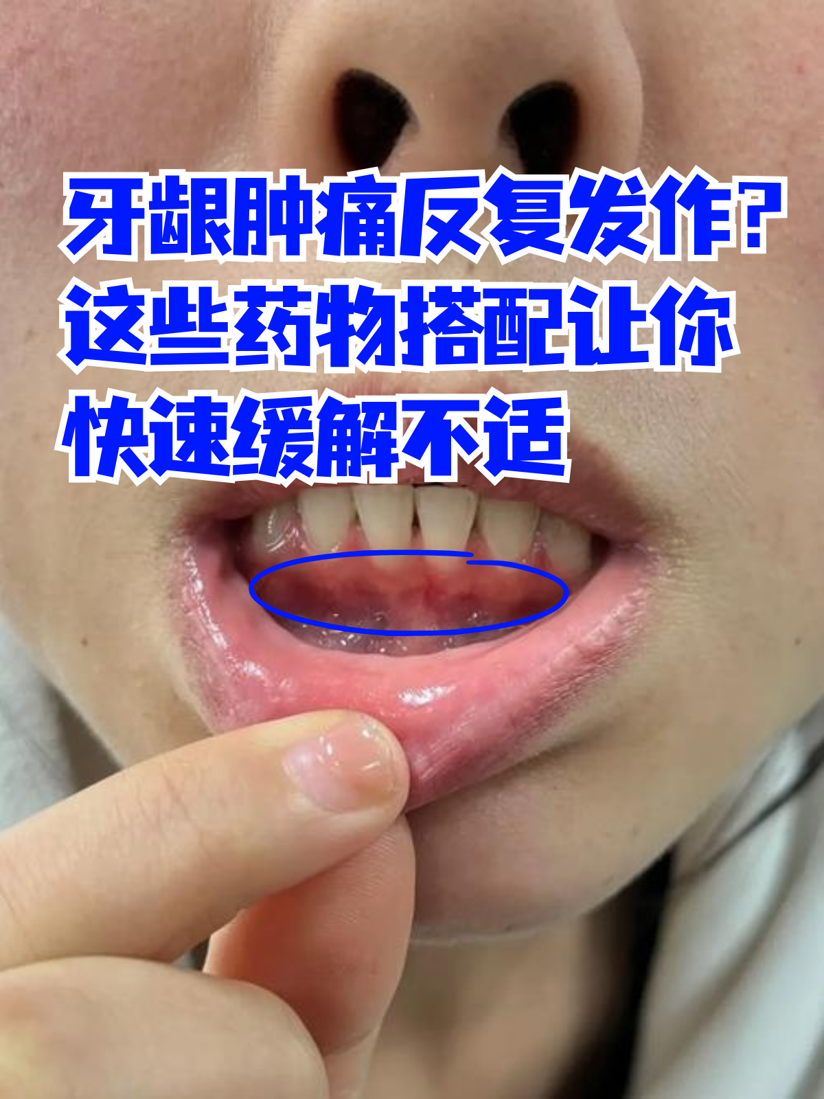 牙龈为什么会肿痛 吃了梨子就不疼了为什么在线