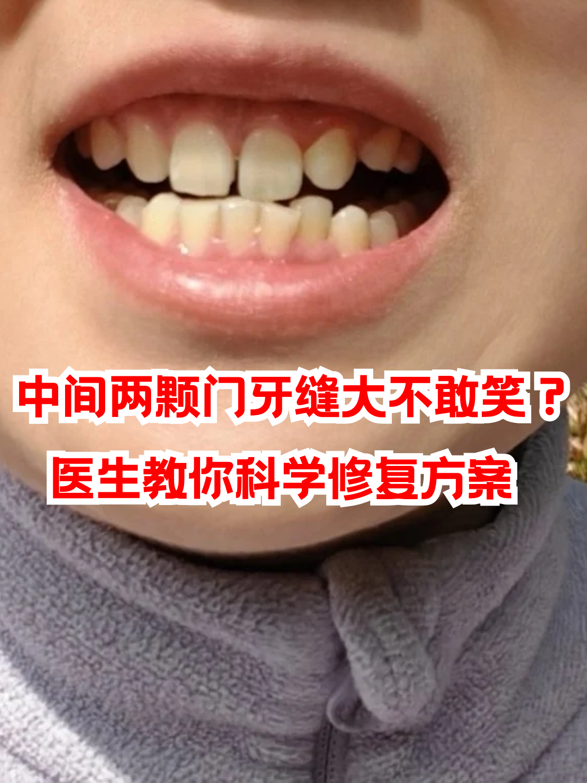 中间两颗门牙缝大不敢笑?