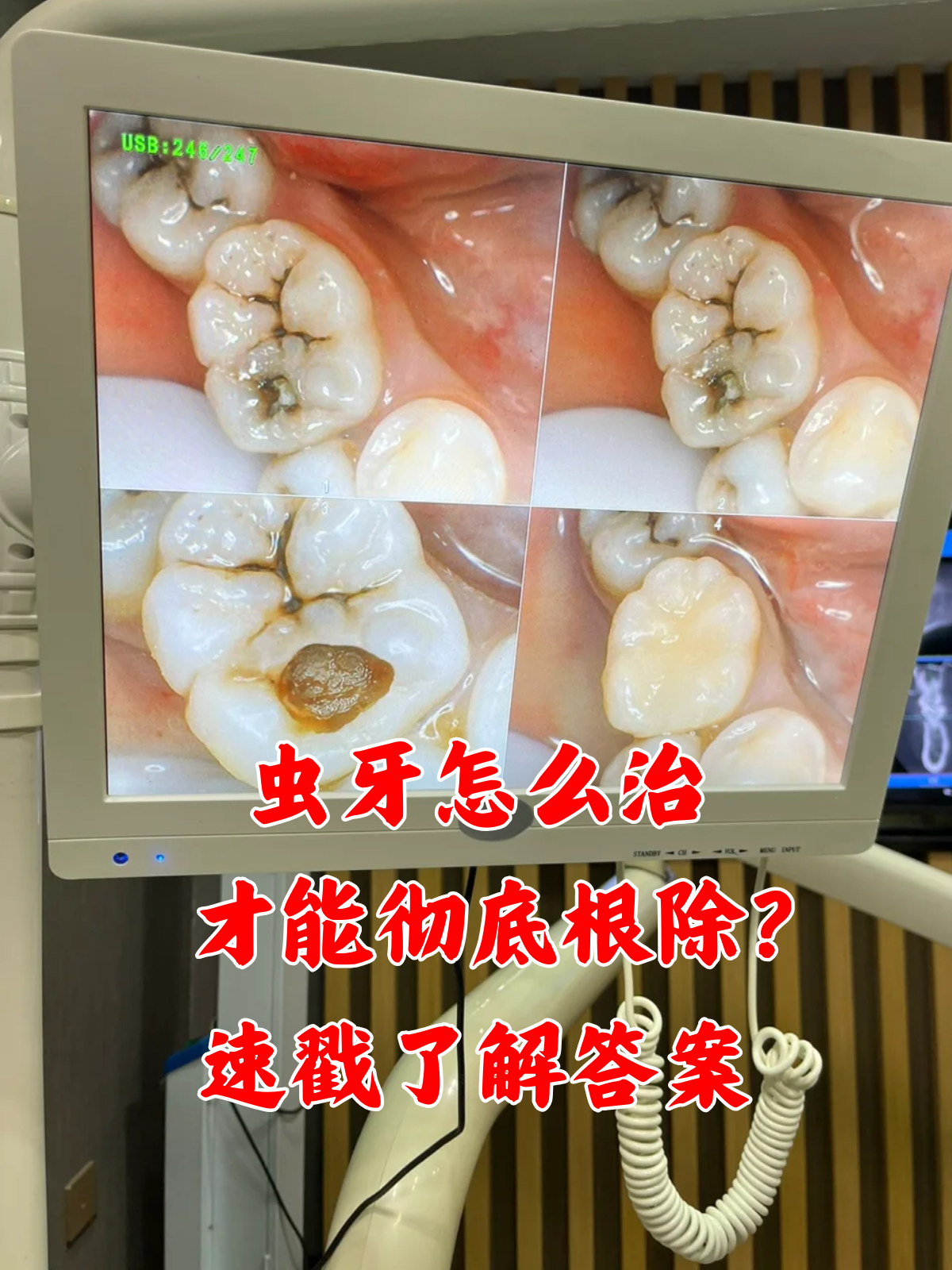 虫牙怎么治才能彻底根除?