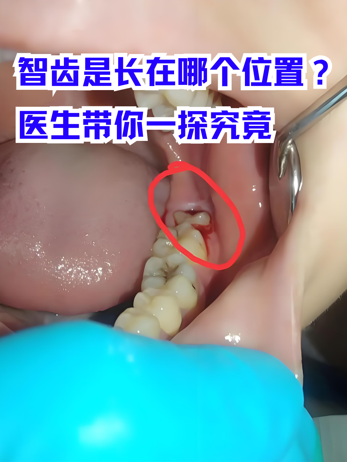 医生带你一探究竟 翻开口腔健康检查报告,"智齿"二字时常出现,不少人