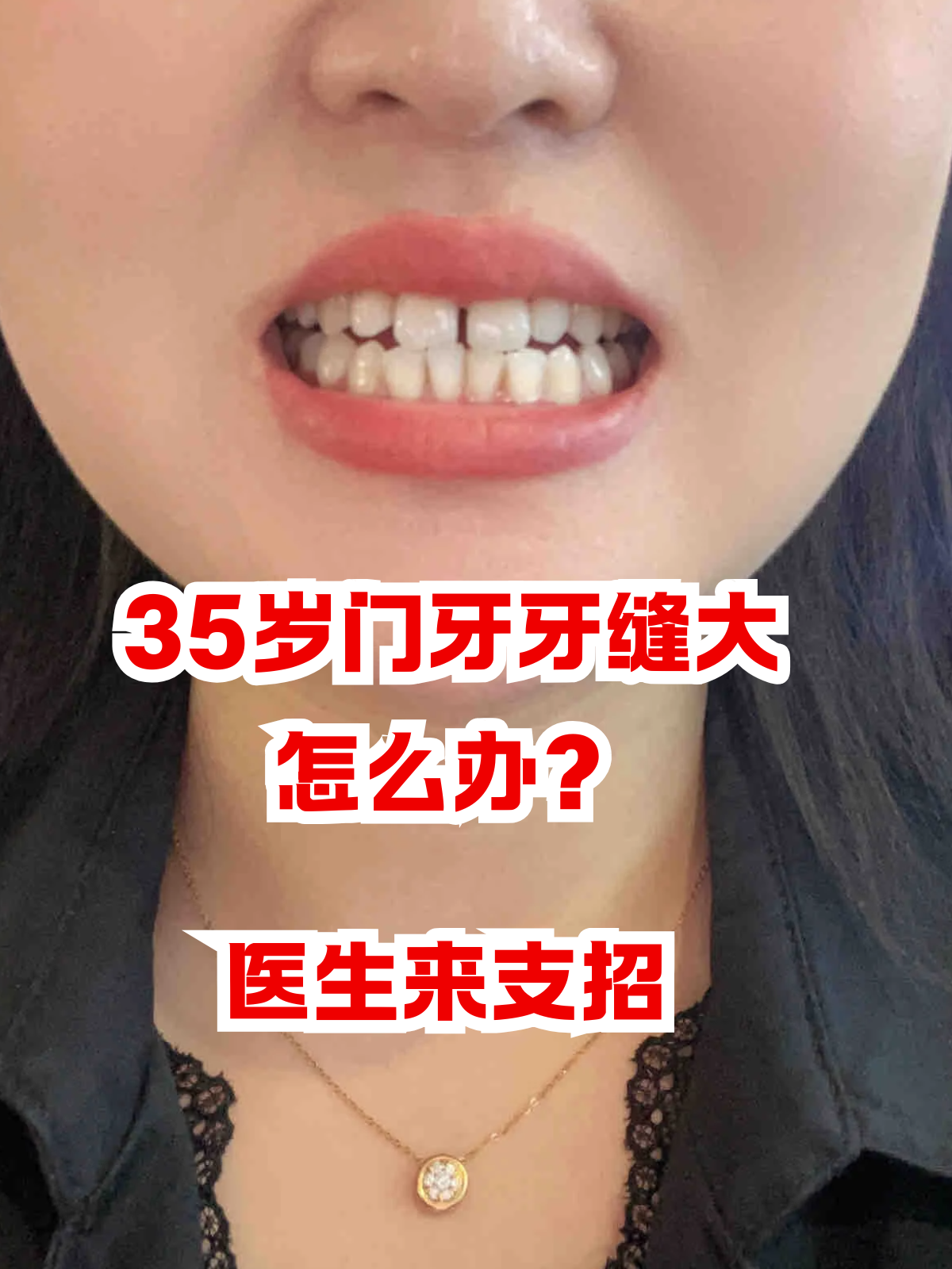 35岁门牙牙缝大怎么办?