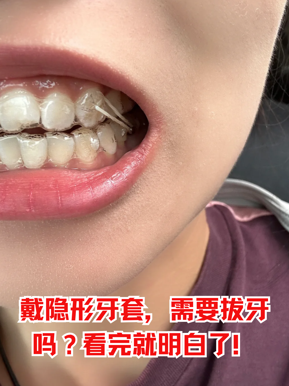 不少人想通过隐形牙套矫正牙齿,却总会纠结一个问题:戴隐形牙套是不