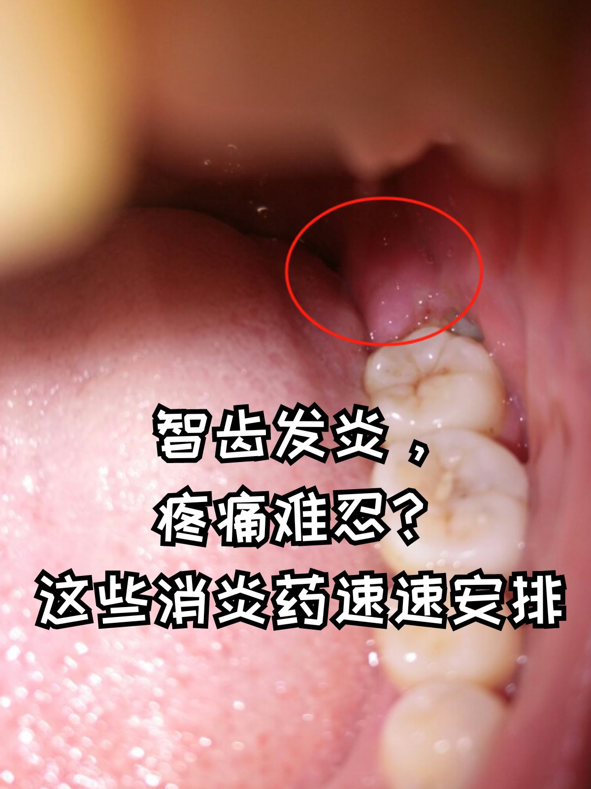 智齿发炎,疼痛难忍?