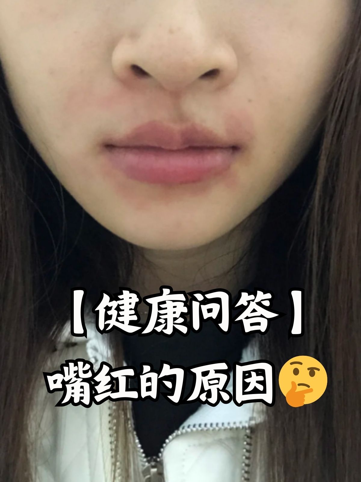 【健康问答】嘴红的原因 嘴红这个问题很常见,但让不少朋友感到有些