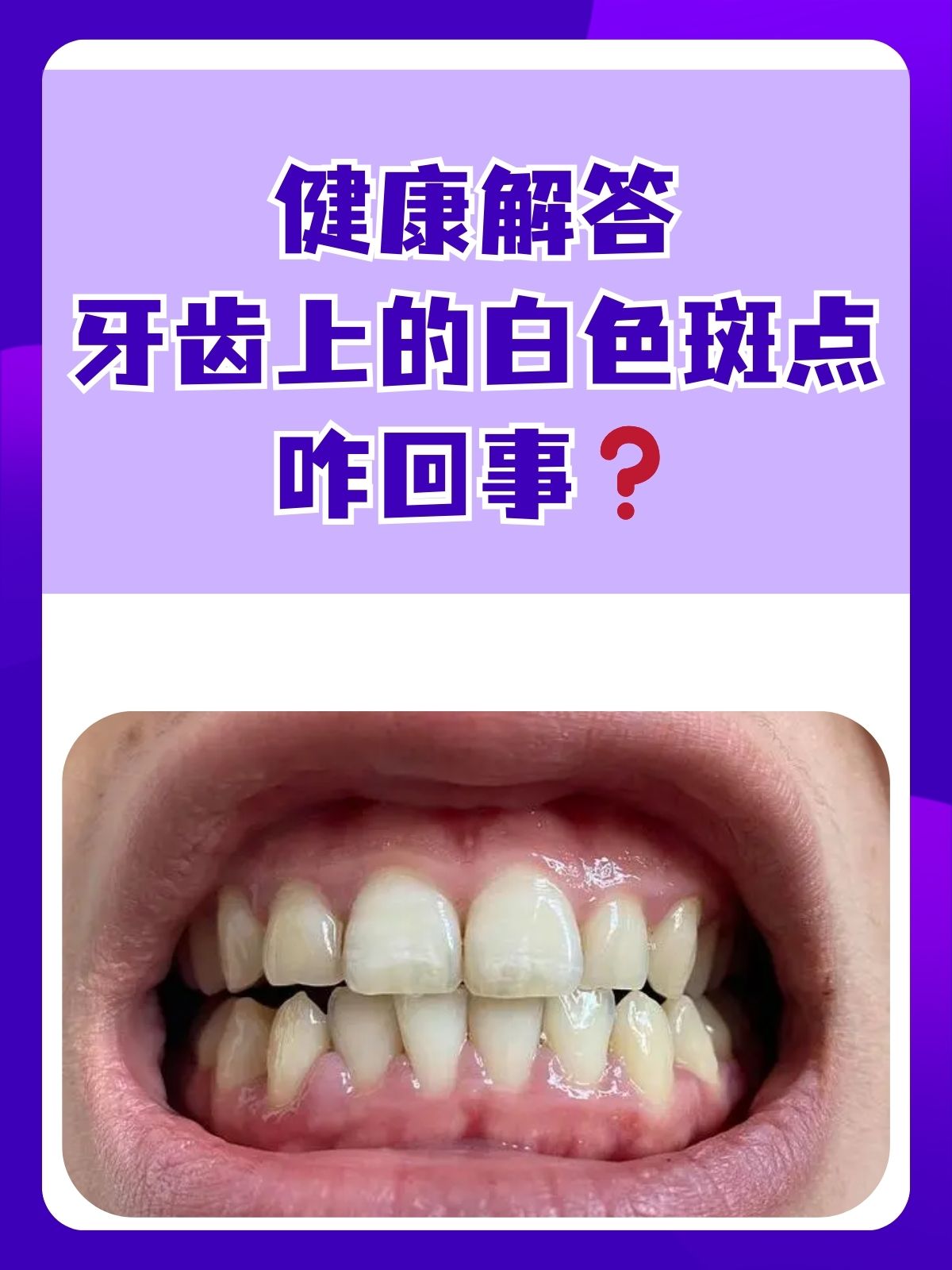 我们的整体健康,有不少朋友比较疑惑:牙齿上出现的白色斑点是怎么回事