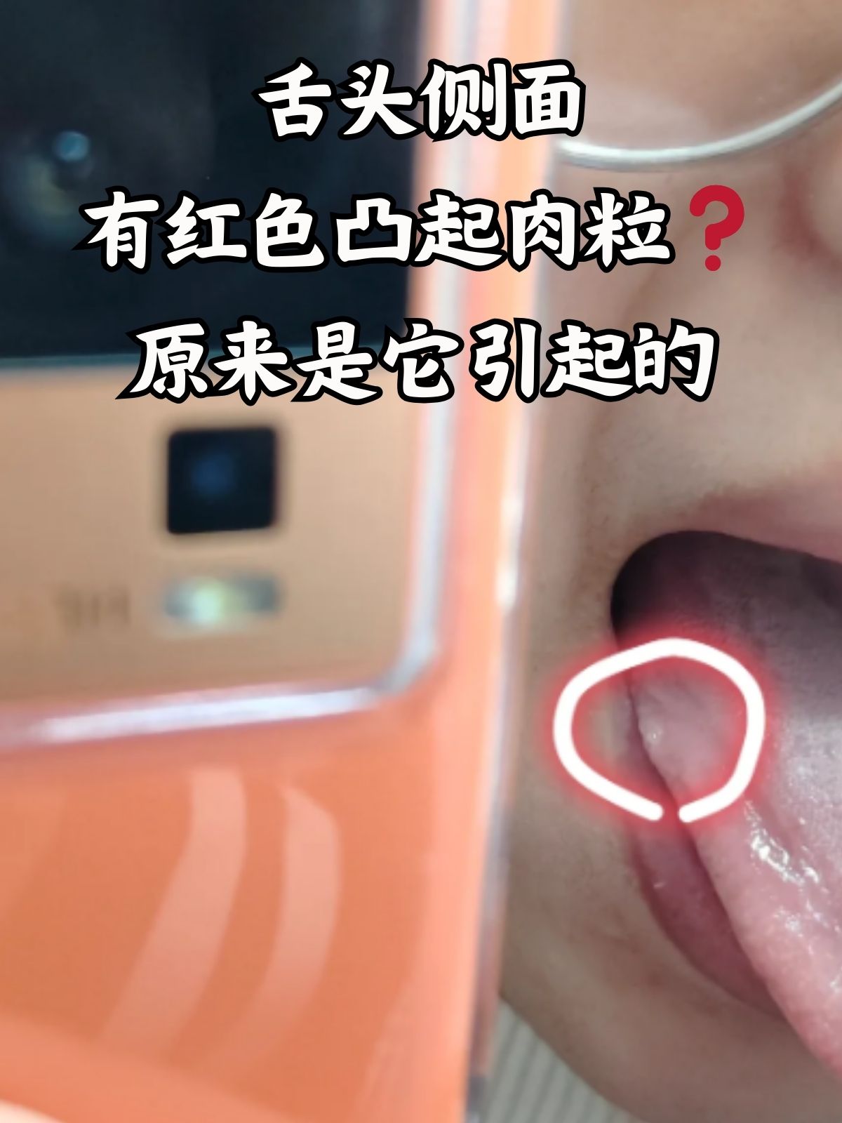 舌头侧面有红色凸起肉粒原来是它引起的 大家有没有在镜子前突然发现