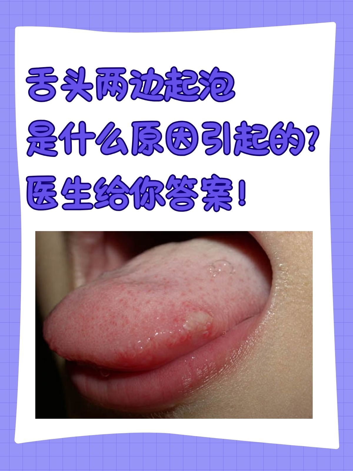 舌头两边起泡是一种较为常见的口腔问题,它不仅带来不适,还可能影响