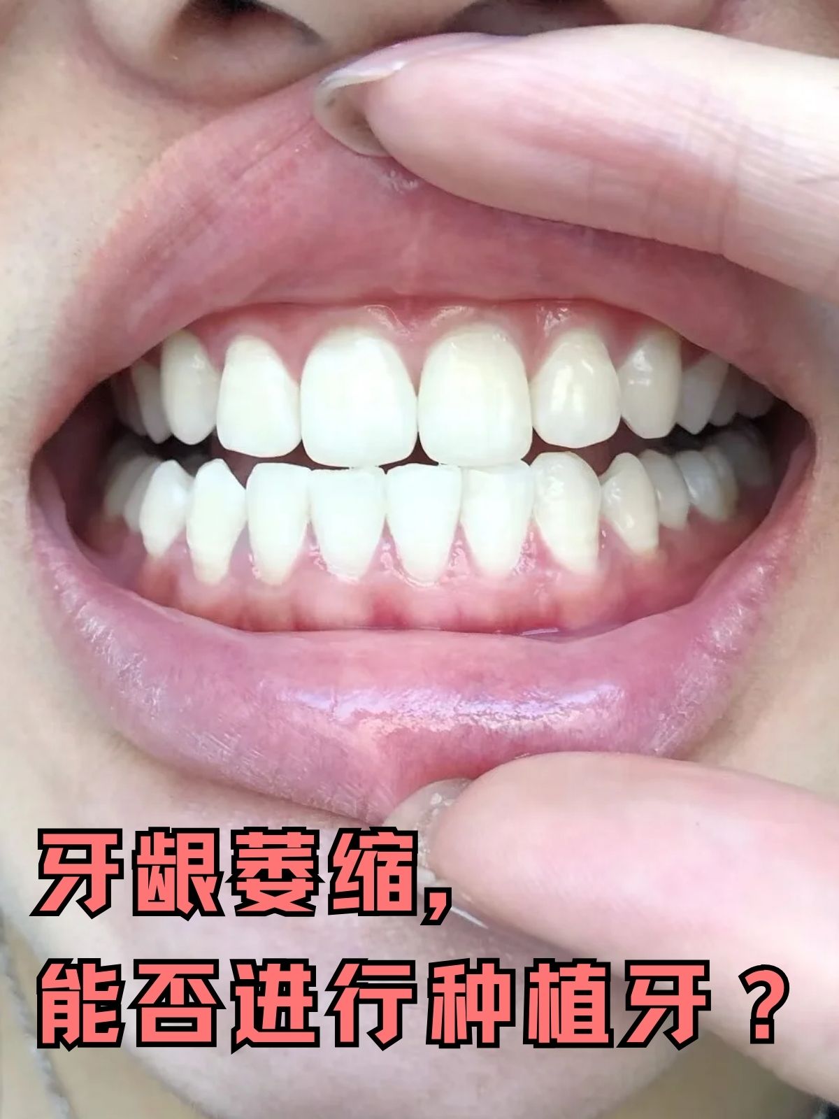 牙龈萎缩,简单来说,就是牙龈缘向牙根方向退缩,导致牙根暴露