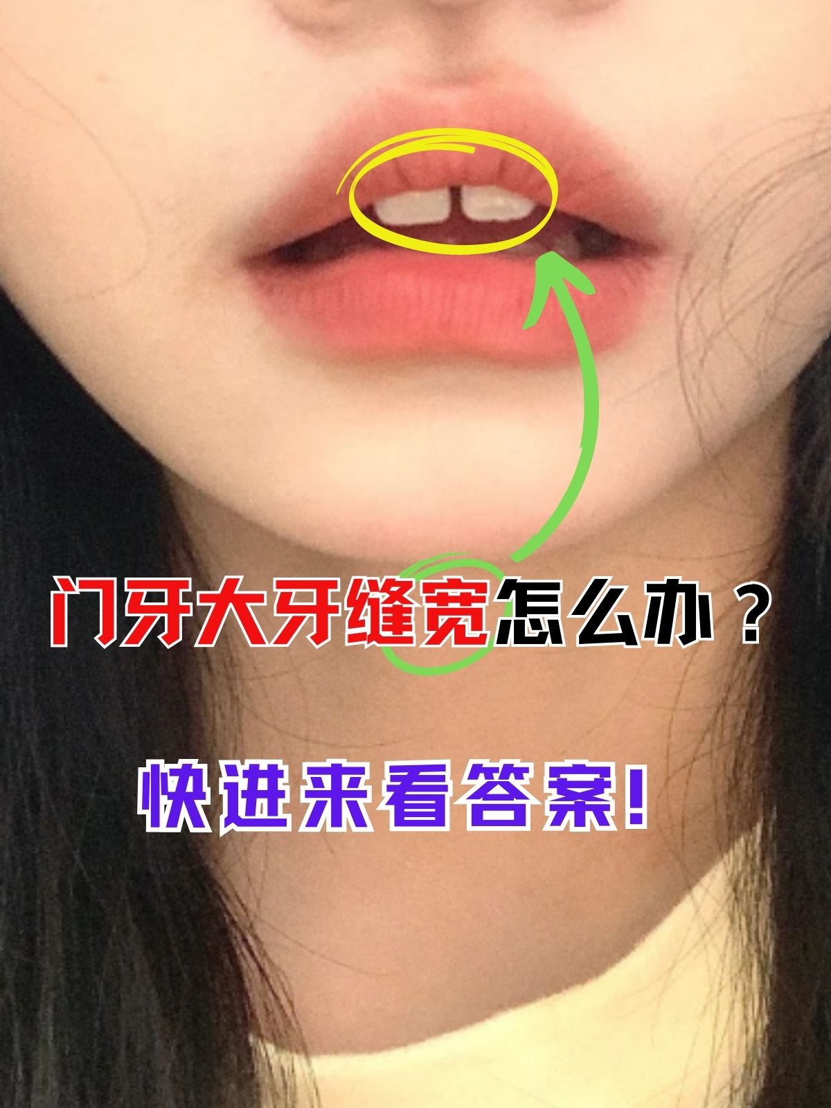 门牙大牙缝宽怎么办?快进来看答案!