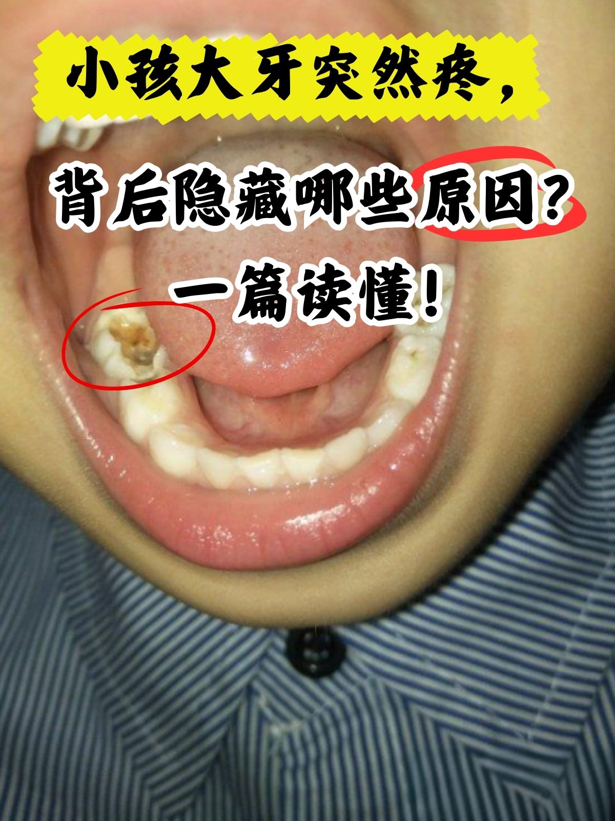 窟窿咋办3岁半宝宝大牙像钟乳石一张嘴就看到牙背面外观完好的牙齿