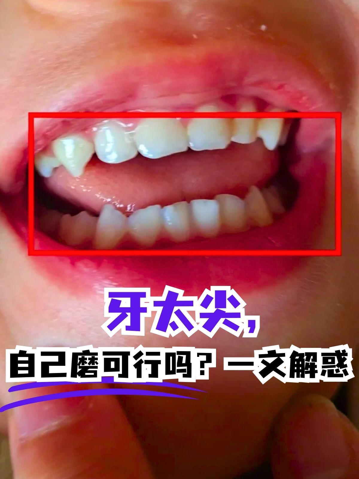 一文解惑 牙齿尖锐可能会影响口腔健康,咀嚼功能和美观,那么牙太尖能