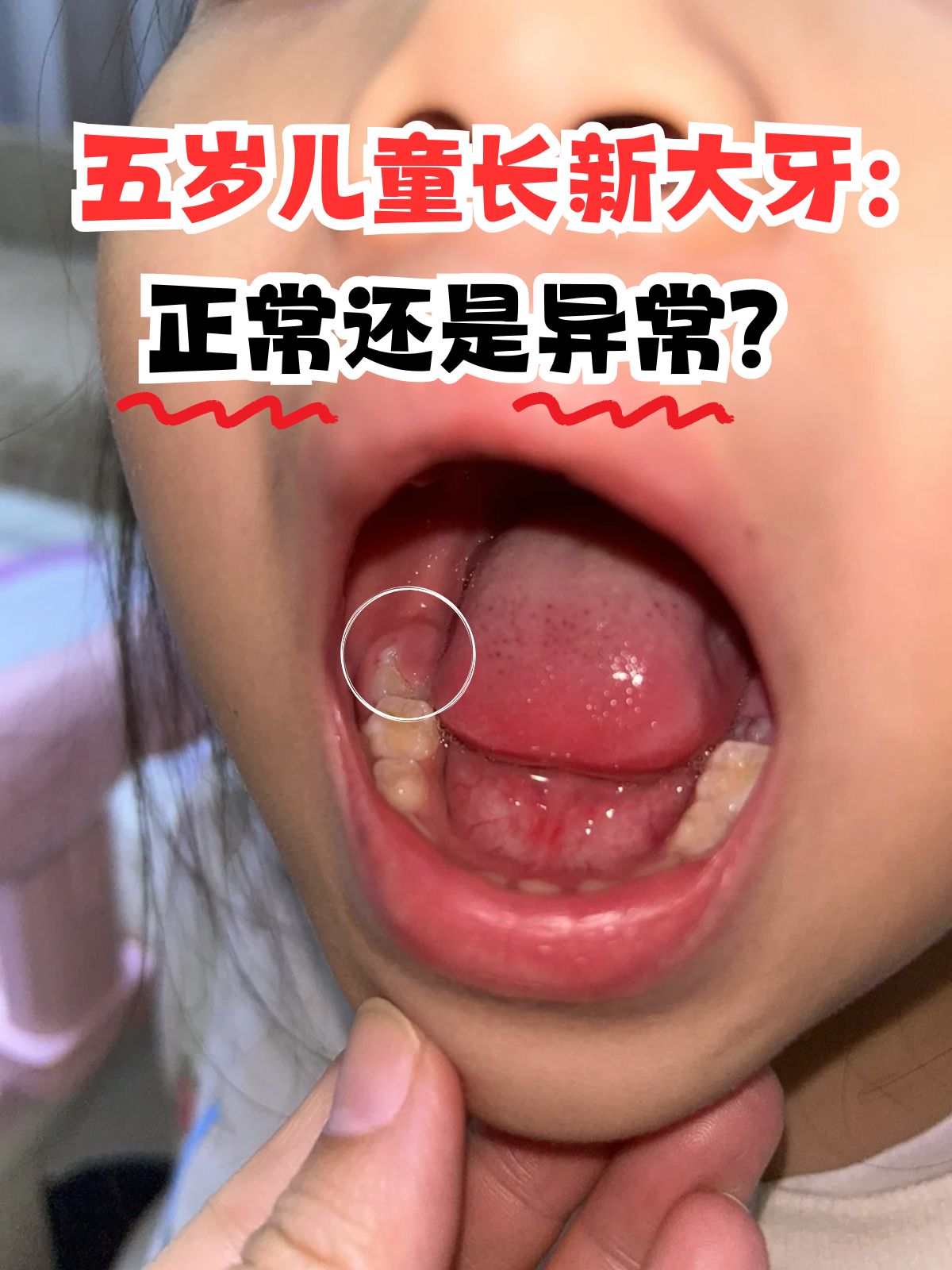 五岁儿童长新大牙:正常还是异常?