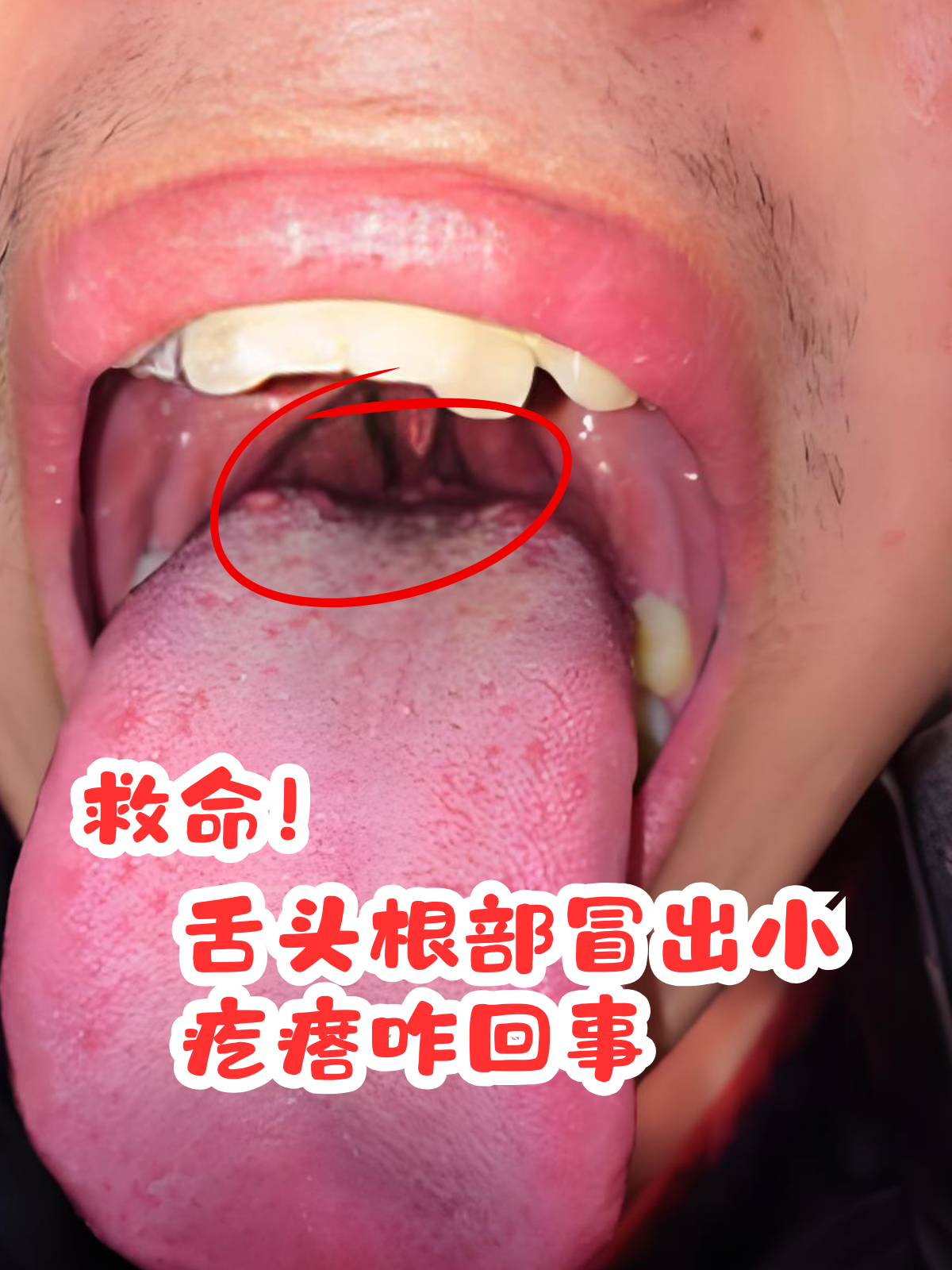 舌头根部冒出小疙瘩咋回事 当我们照镜子,突然发现舌头根部起了疙瘩