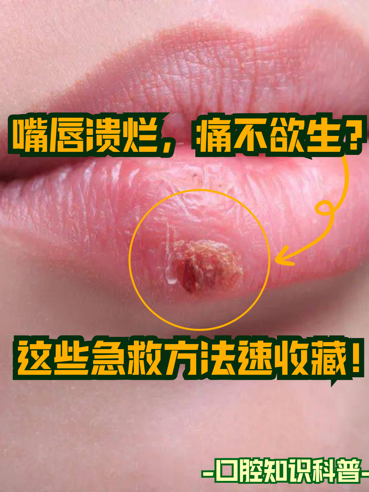 在日常生活中,不少人都遭遇过嘴唇溃烂的情况,这不仅会影响美观,还会