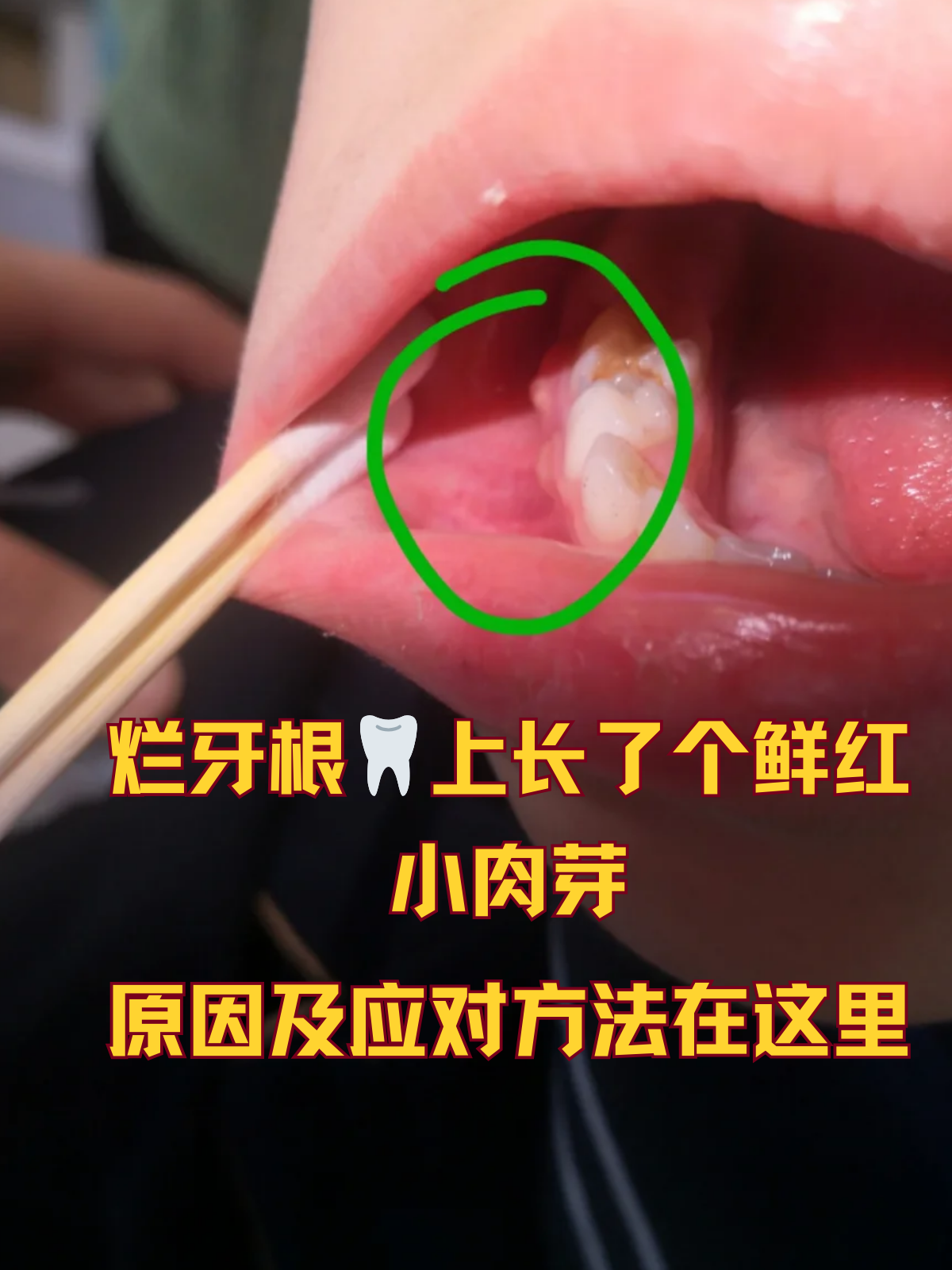 烂牙根上长了个鲜红小肉芽,原因及应对方法在这里 当你在镜子前准备好