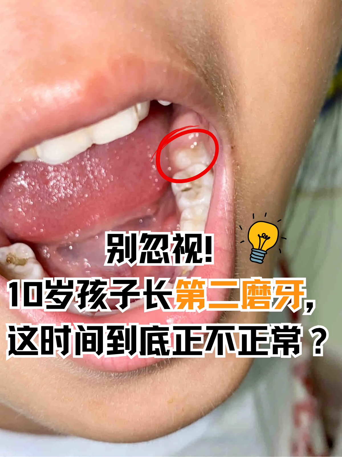 10岁孩子长第二磨牙,这时间到底正不正常?