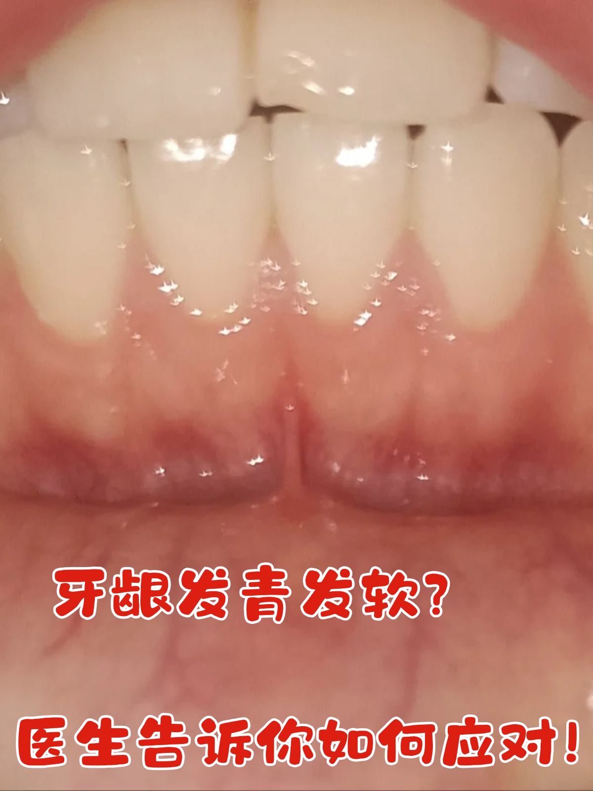 牙龈发青发软这个问题不仅影响美观,还可能隐藏着口腔健康的隐患