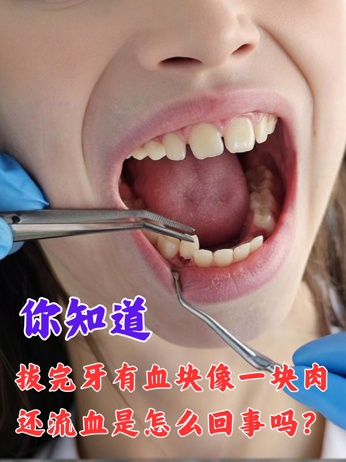 你知道,拔完牙有血块像一块肉还流血是怎么回事吗?