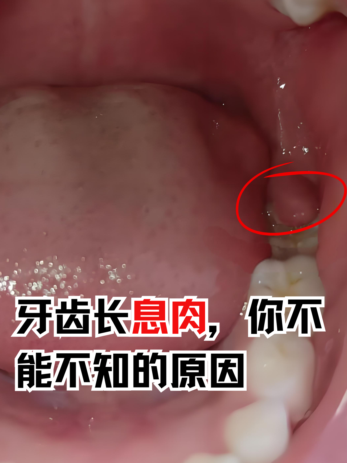 包含为什么会长息肉是什么原因引起的的词条