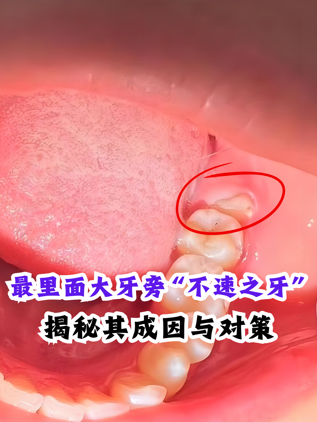 成年了为什么还会长智齿百科在线
