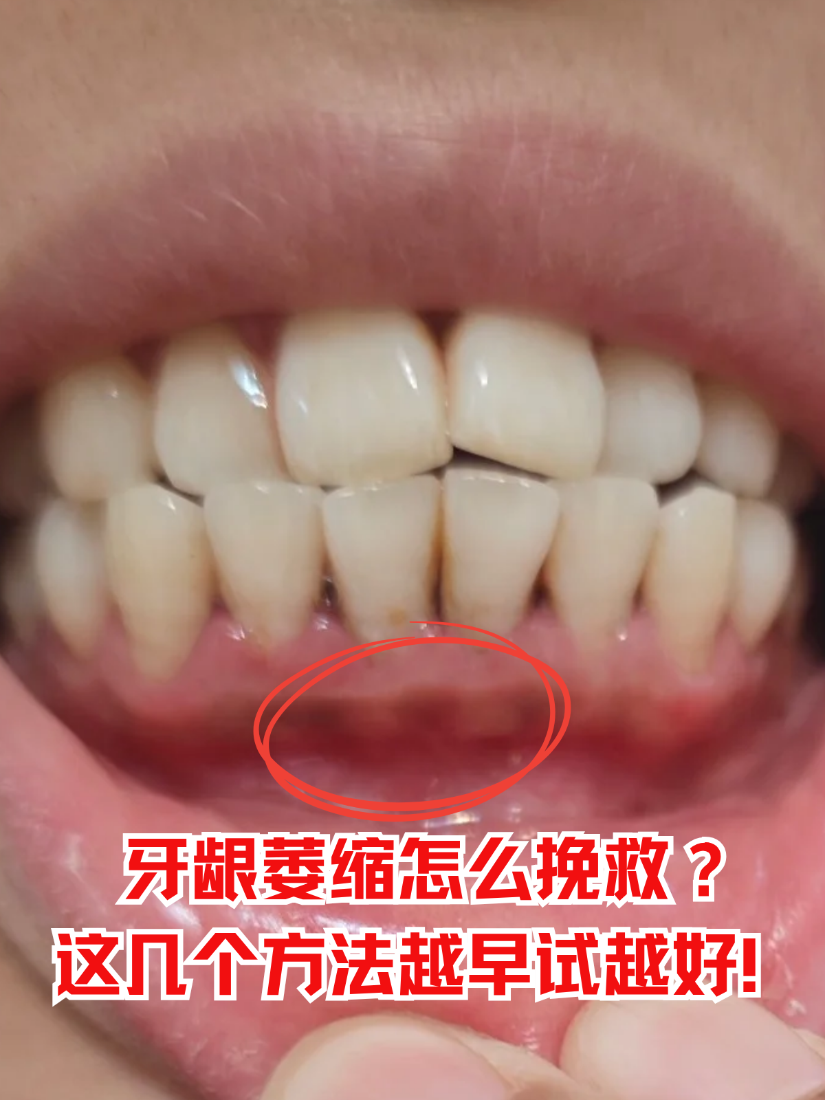 "作为口腔科常见问题,牙龈萎缩虽不可逆,但通过科 牙龈萎缩最严重图片