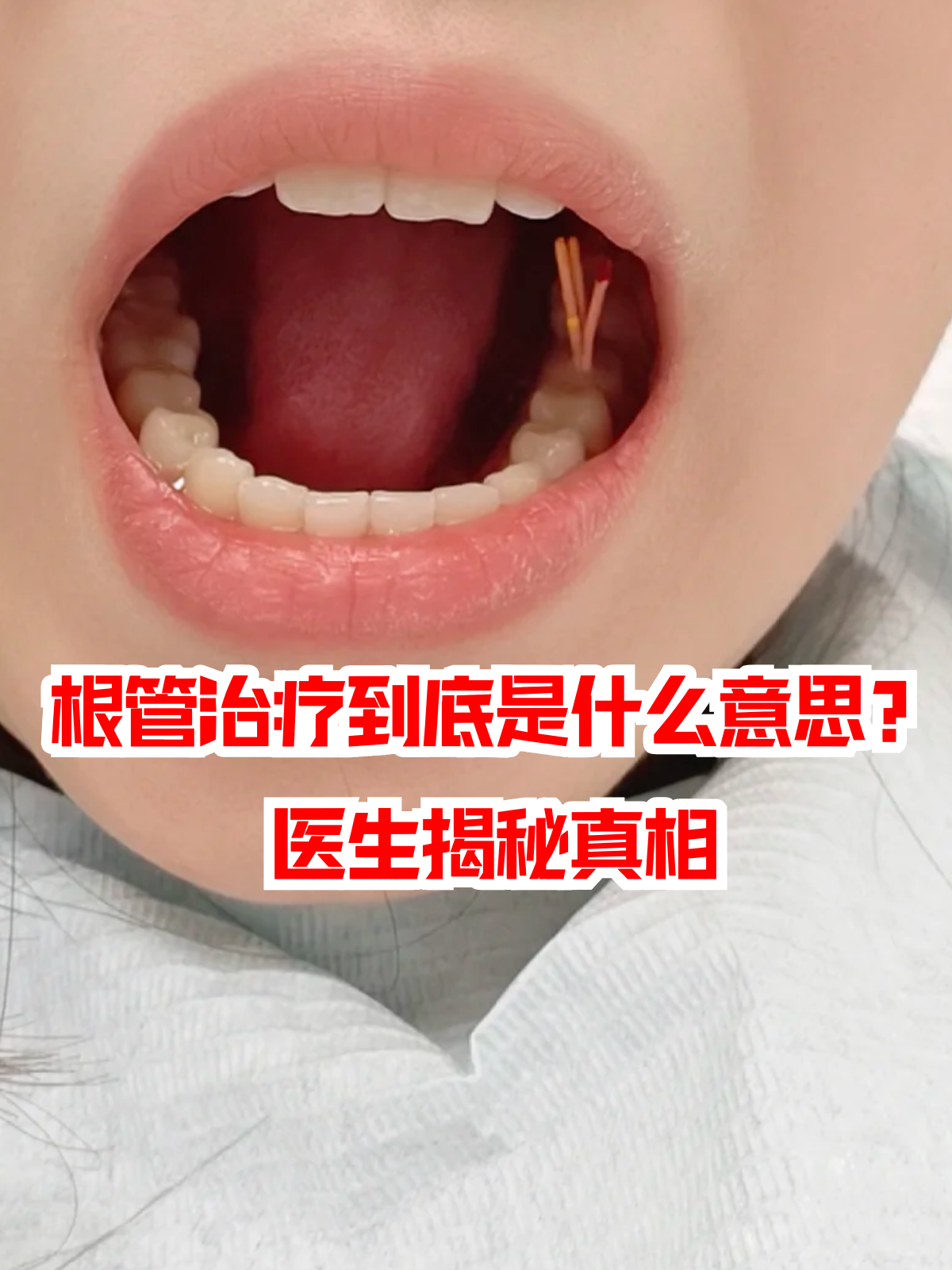 牙齿做了根管治疗为什么还会痛