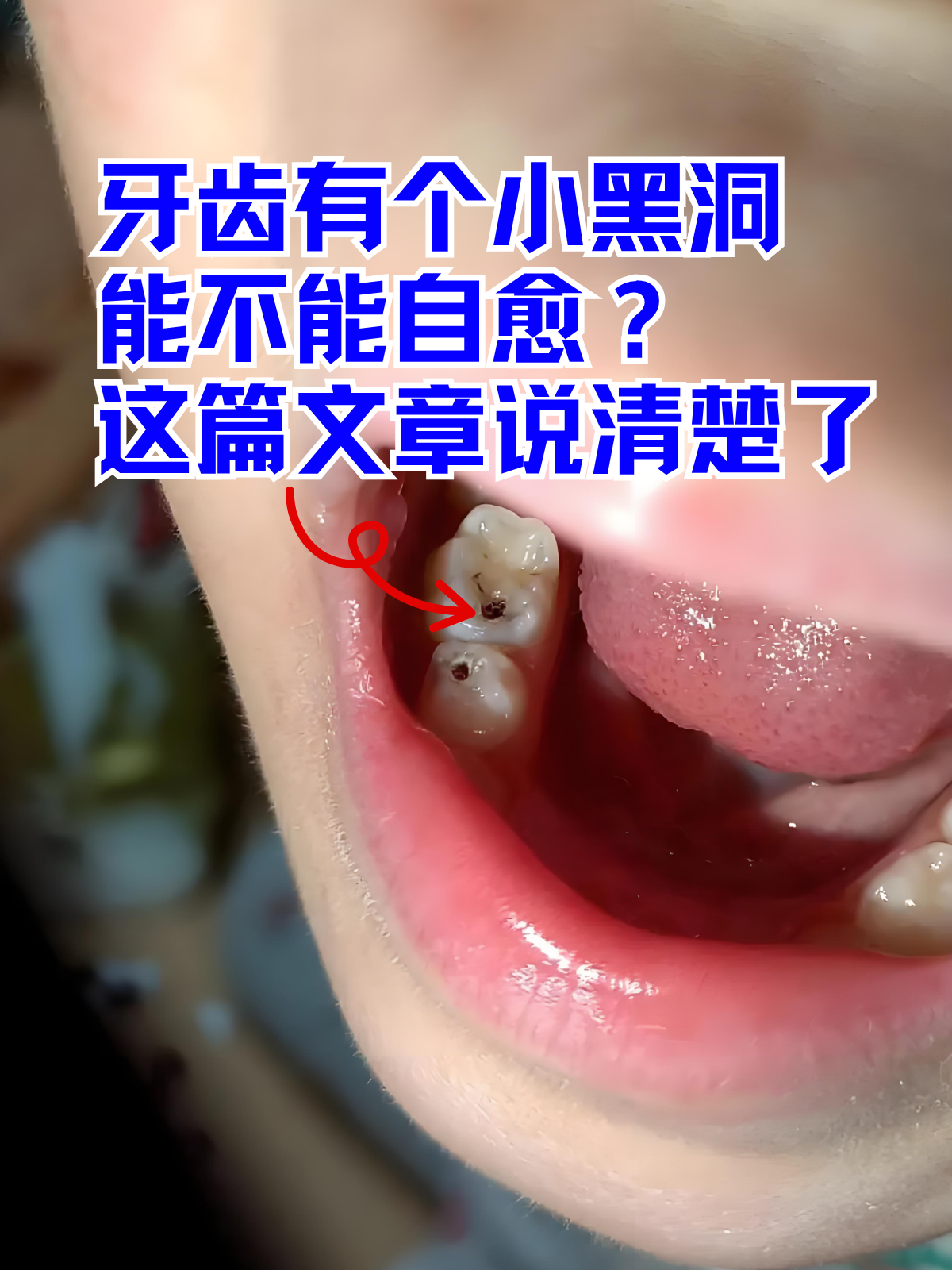这篇文章说清楚了 当你对着镜子发现牙齿表面出现一个小黑洞,或许会心