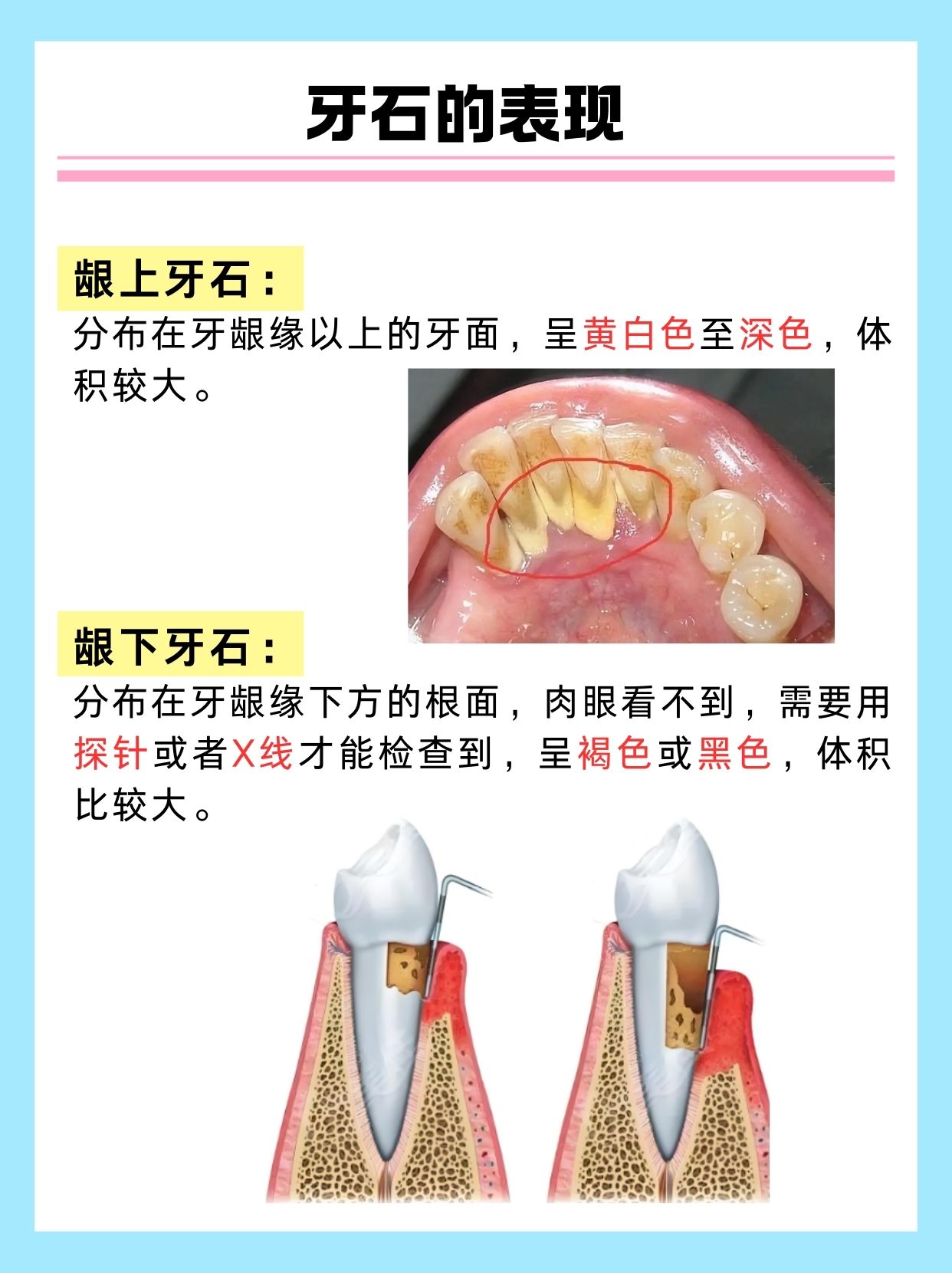 牙结石是牙菌斑和食物残渣钙化形成的硬块