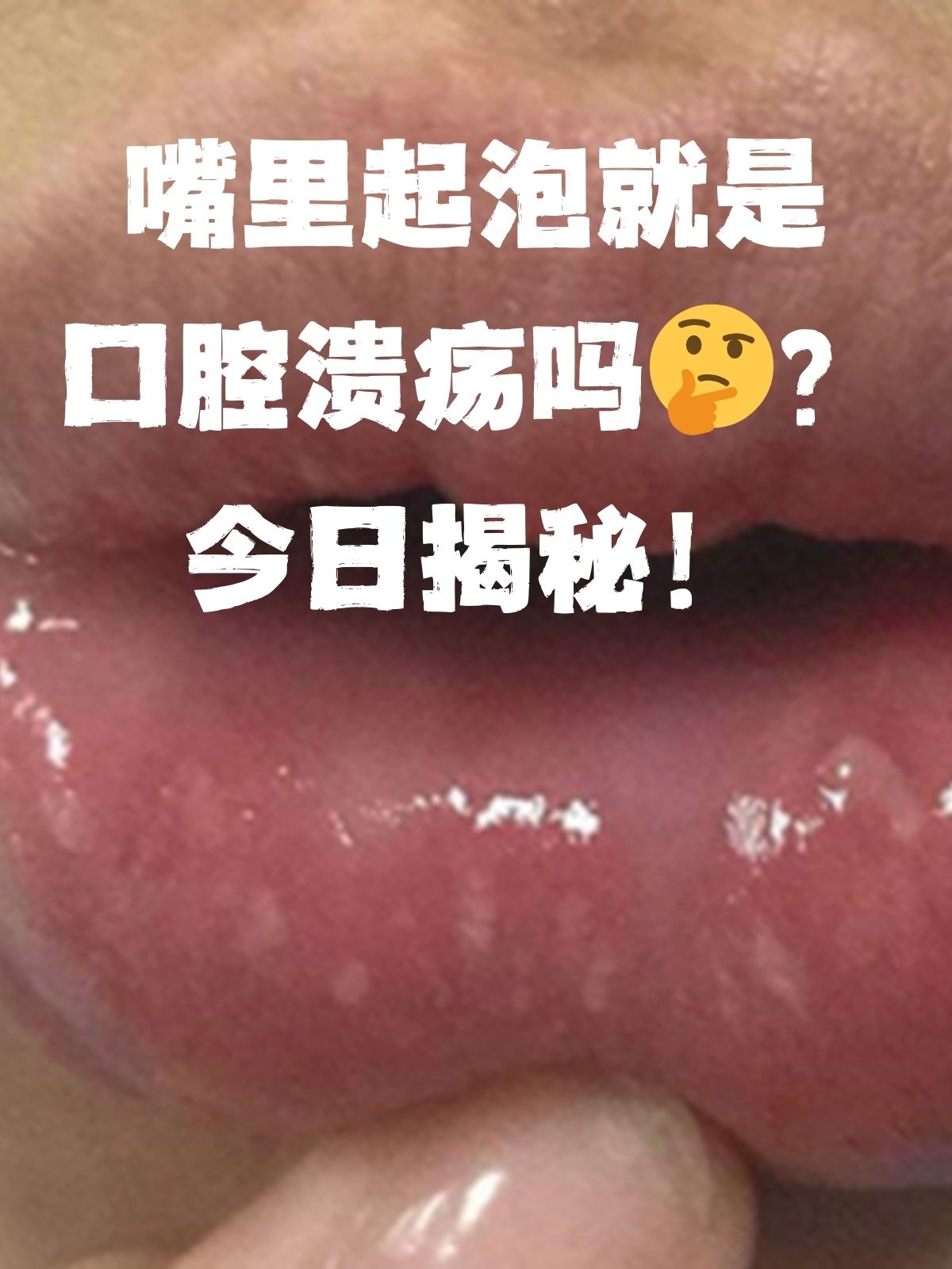 嘴巴起水泡是什么原因图片