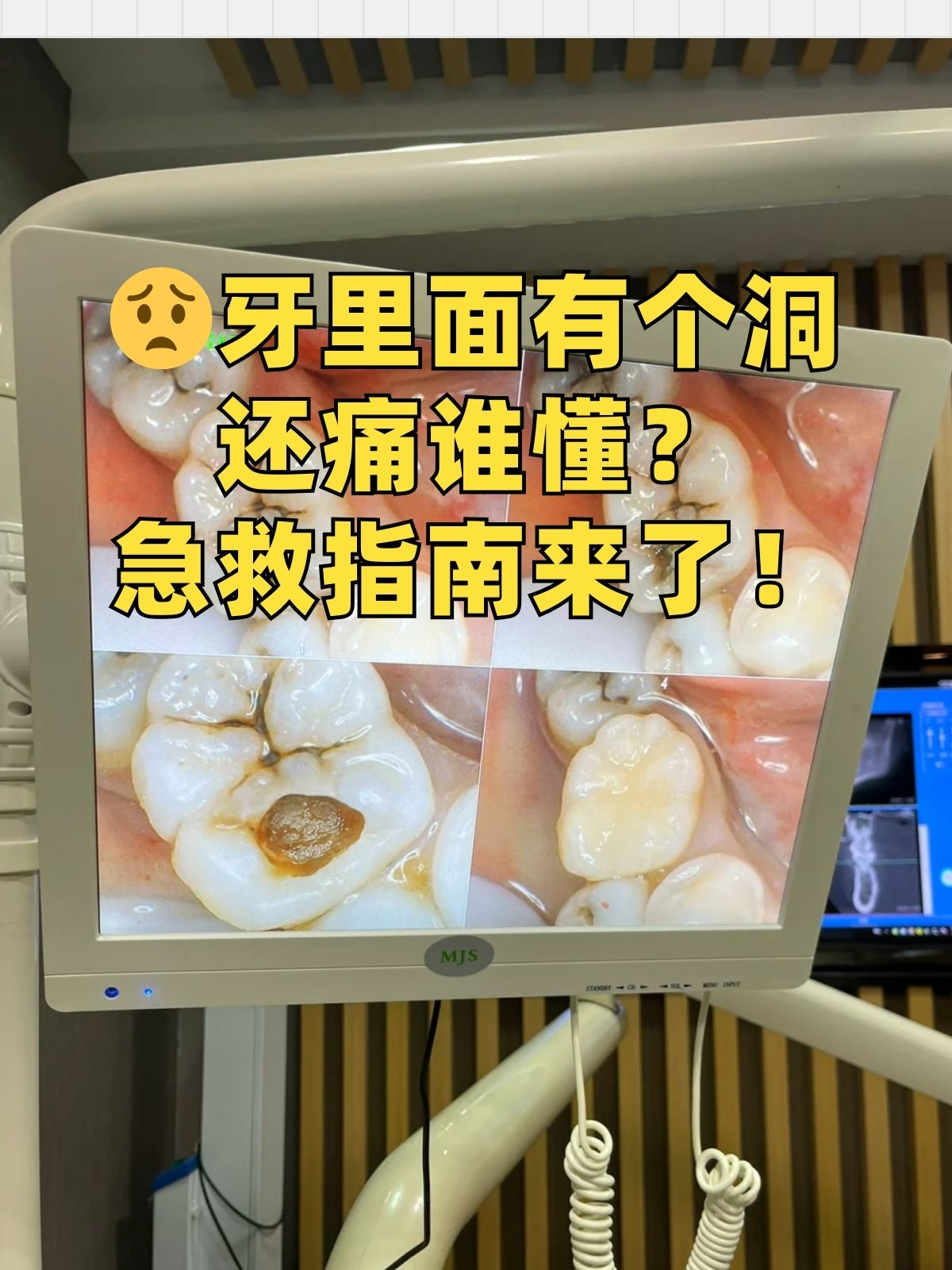 突然牙齿一阵剧痛袭来,仔细一看,发现疼的那颗牙里面居然有个洞,这可