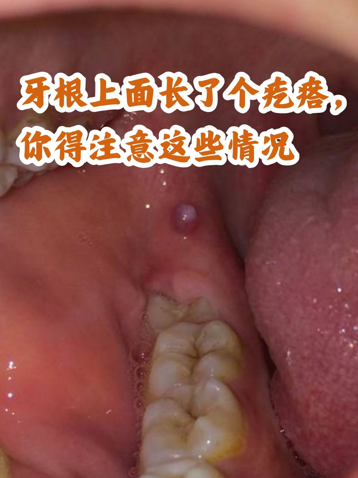 牙根腐烂怎么办图片