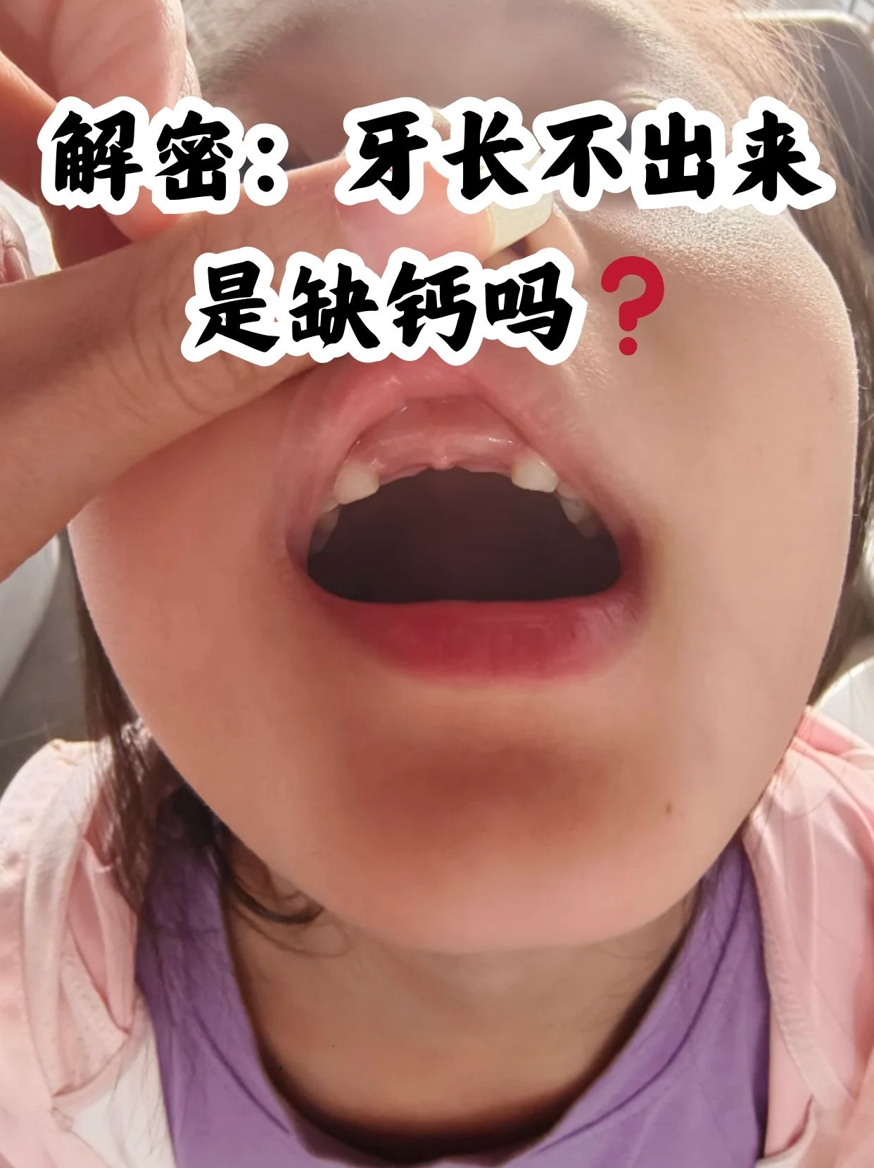 缺钙牙齿的症状图片图片