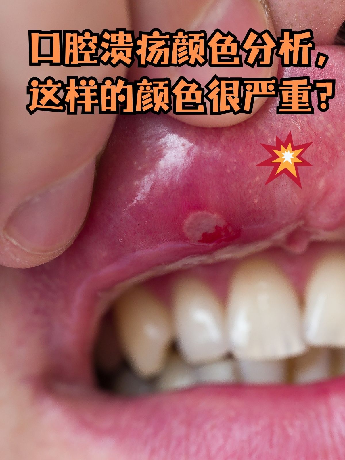 口腔溃疡是一种常见的口腔问题,相信很多人都曾经被它困扰过
