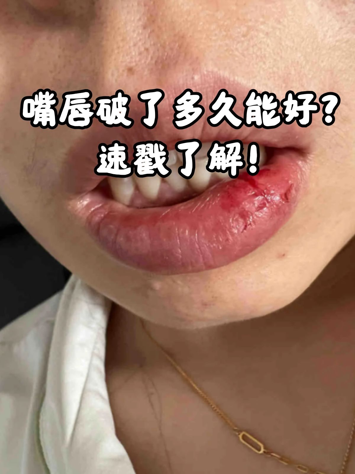 经常咬嘴唇,舔嘴唇?吃东西时嘴巴张得太大?