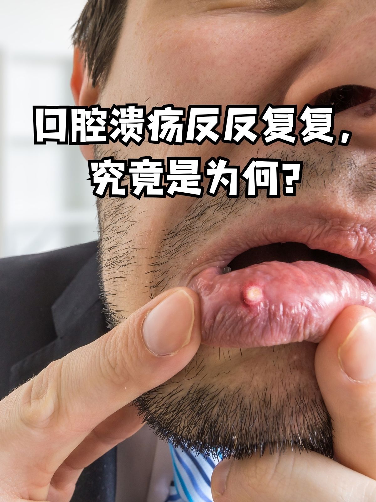 为什么容易长口腔溃疡