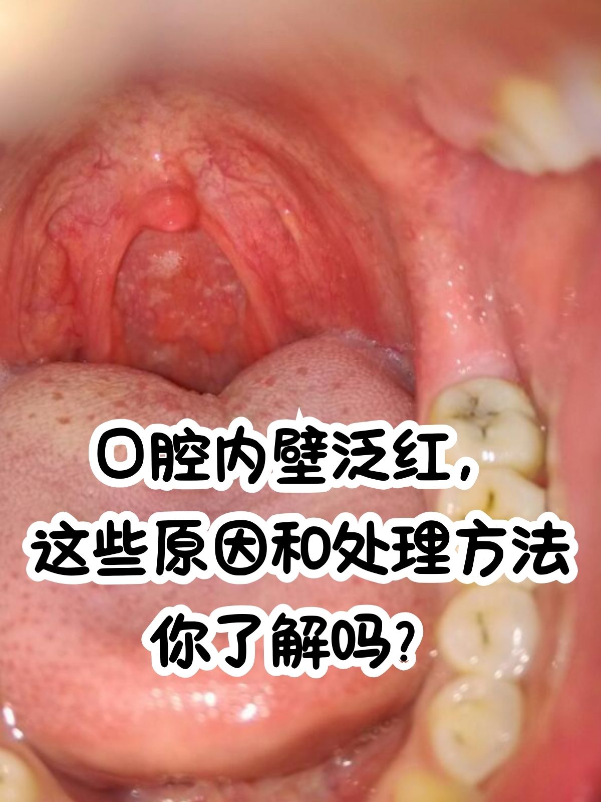 舌腭弓慢性充血图片