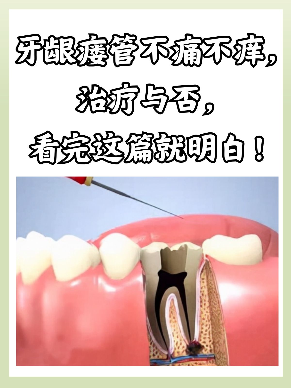 瘘管图片根尖瘘管牙齿瘘管图片根尖瘘管图片牙龈瘘管怎么治疗牙龈瘘管