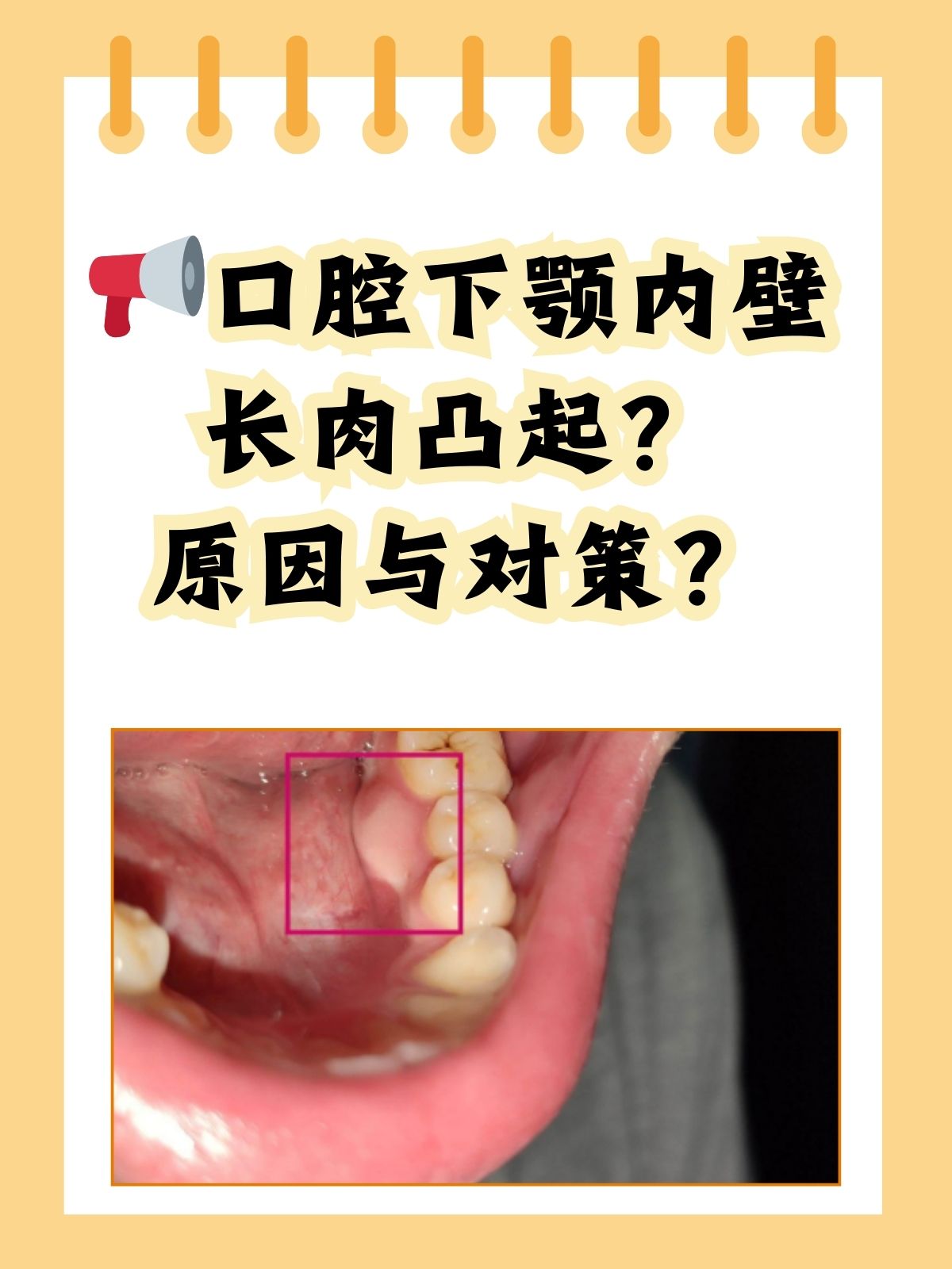 口腔下颚内壁长肉凸起?原因与对策?