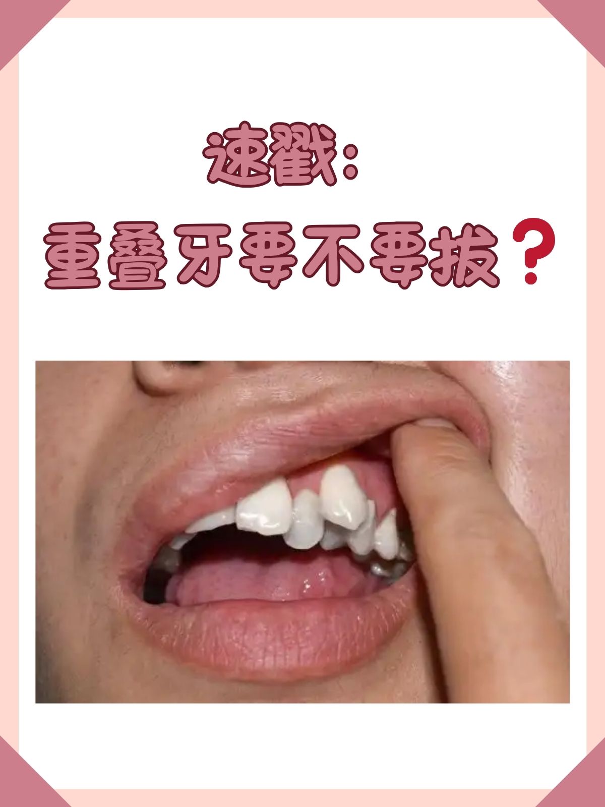 速戳:重叠牙要不要拔 重叠牙即在牙齿生长排列过程中,由于口腔空间不