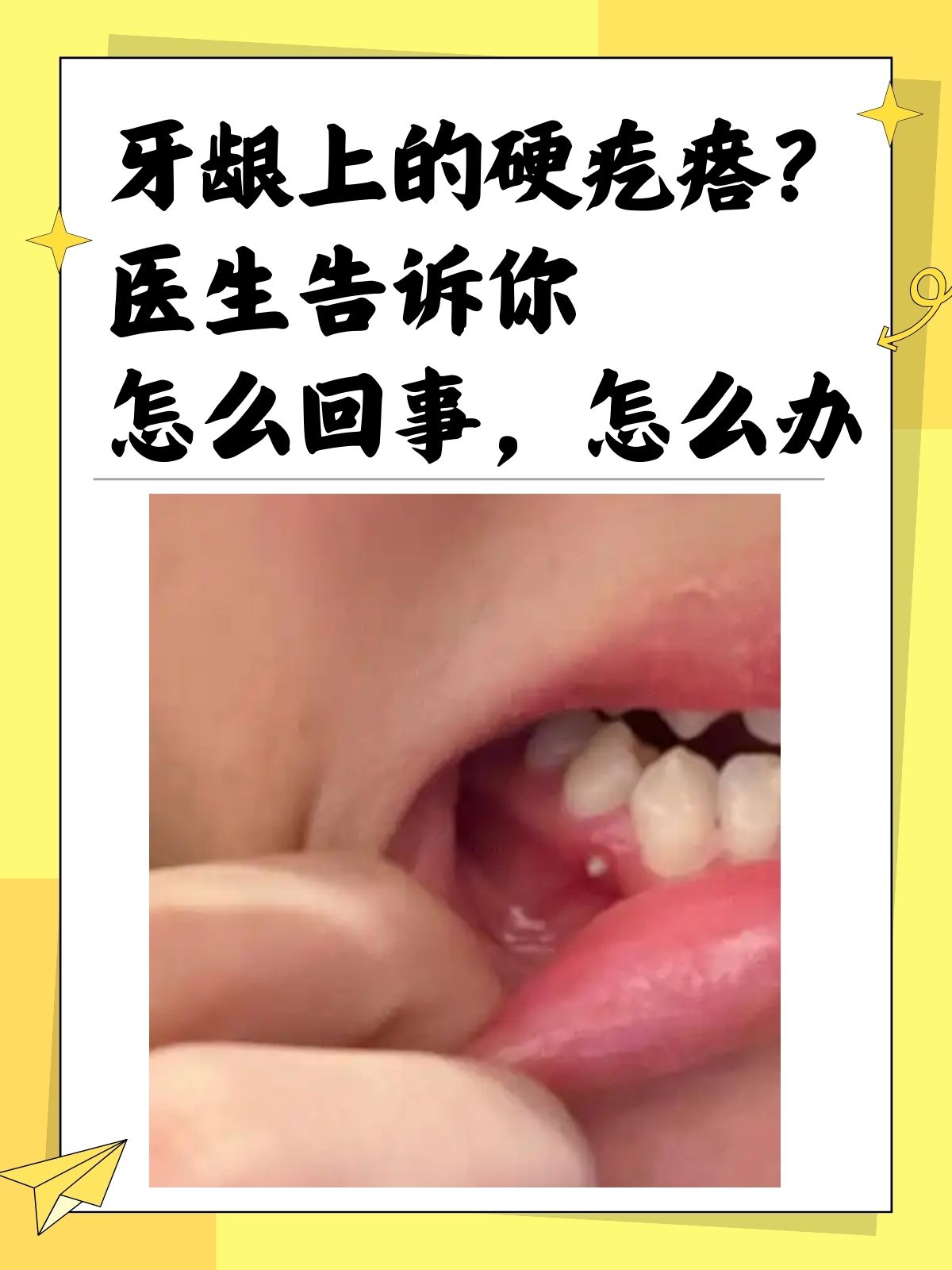 消下去牙齿根部凸起像骨头一样牙龈长了一个凸起的包牙床子鼓包怎么